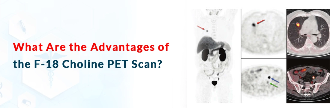  What Are the Advantages of the F-18 Choline PET Scan?